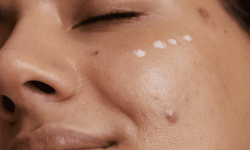 Acne: De onbalans van de C. Acnes bacterie