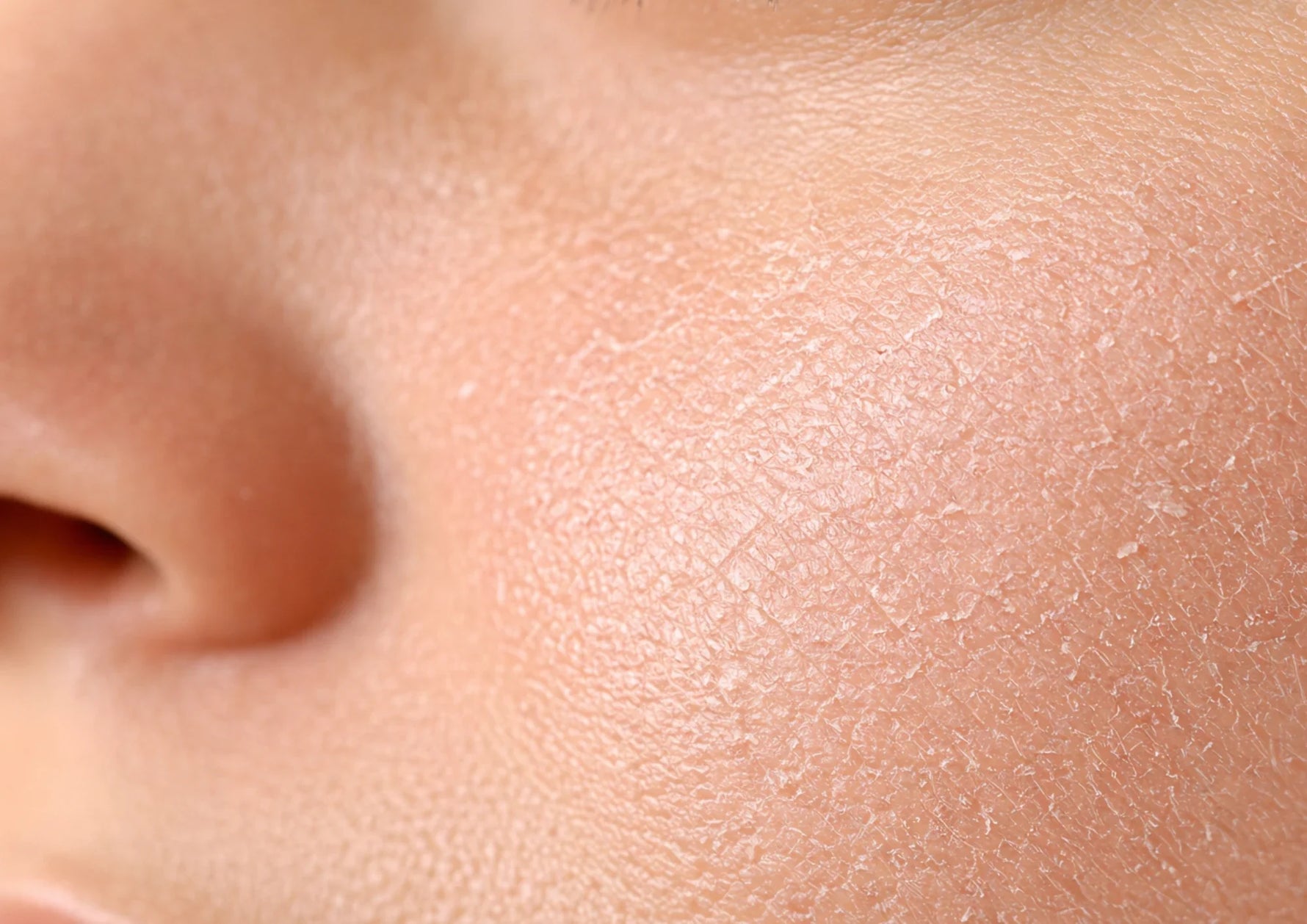 Droge / vochtarme huid