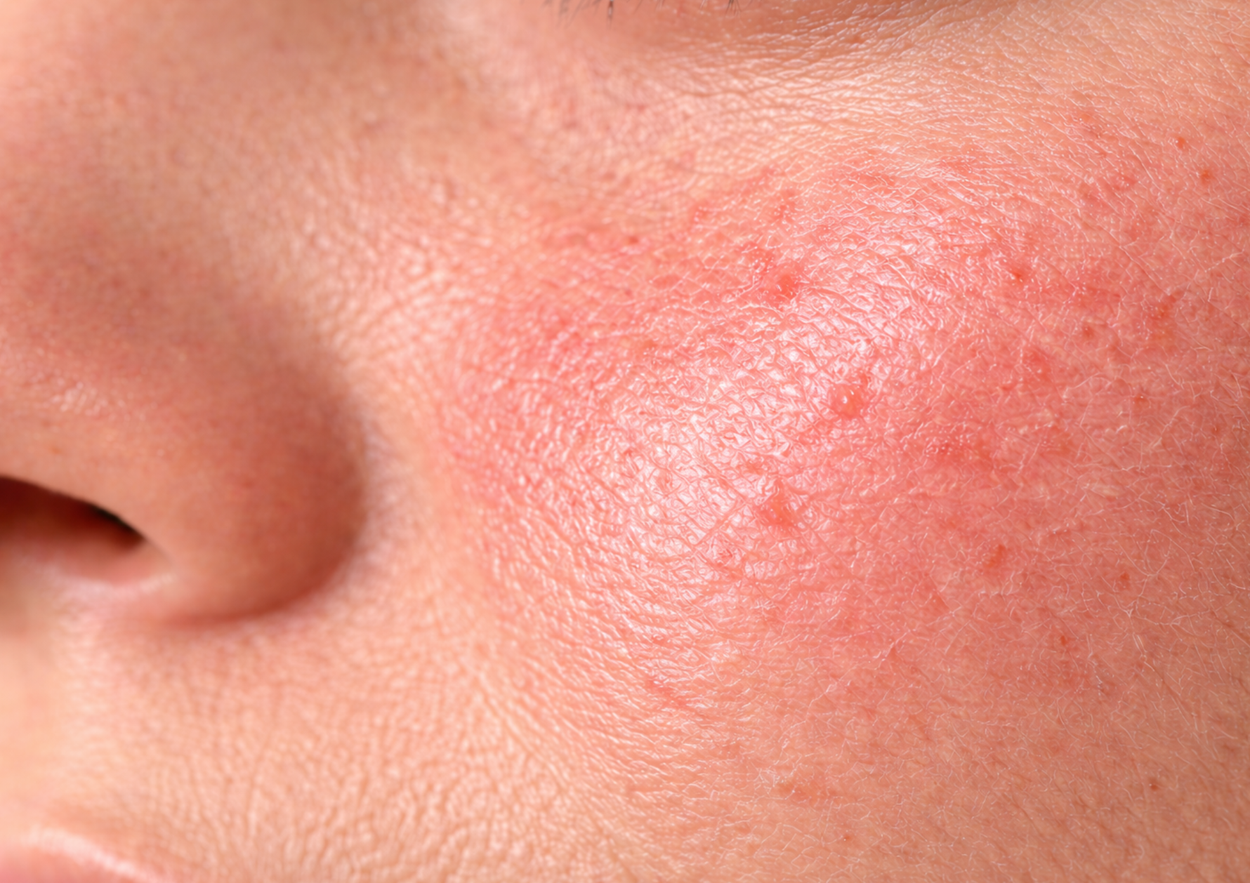 Huid met tekenen van roodheden