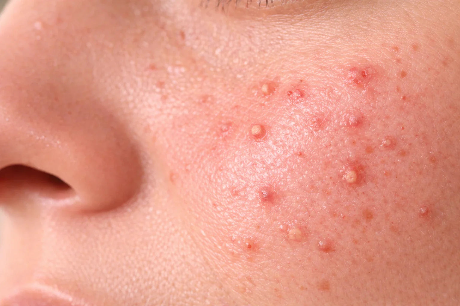 Huid met tekenen van onzuiverheden en acne